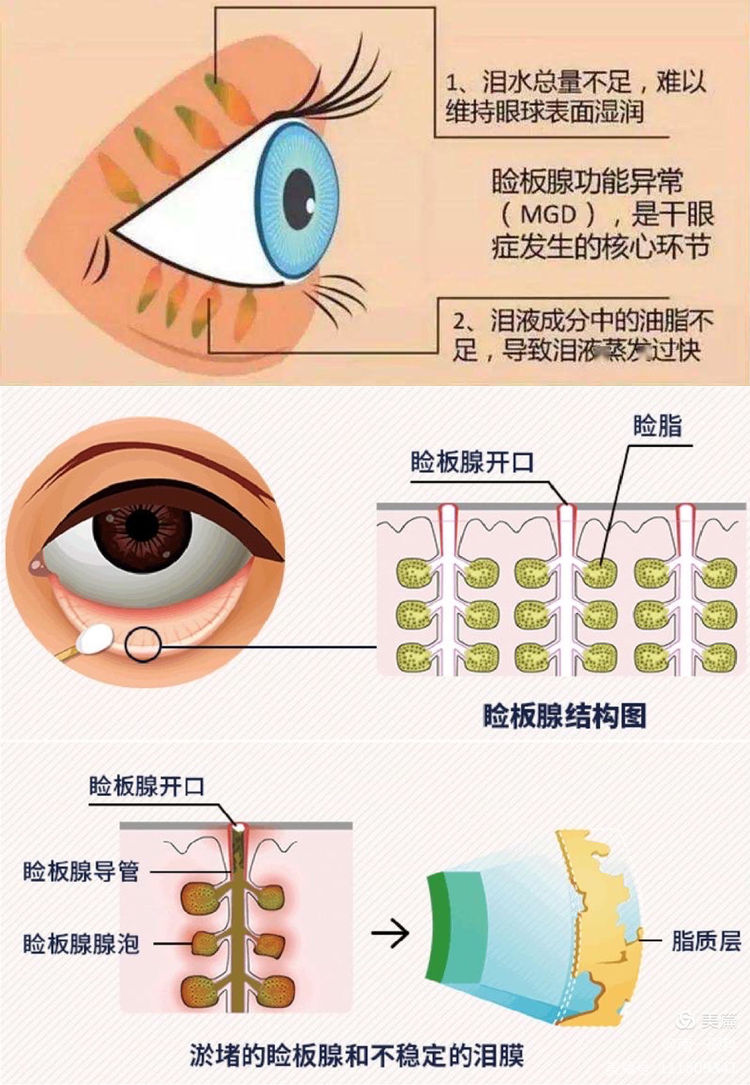 睑板腺功能障碍型干眼