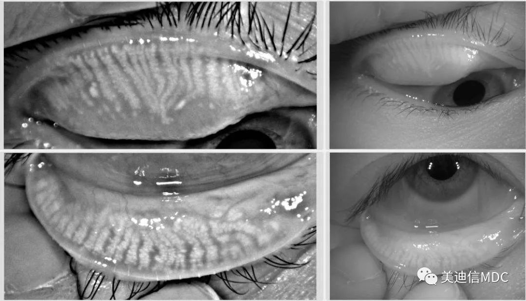 睑板腺功能障碍型干眼MGD
