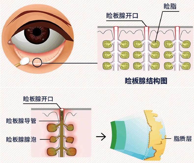 睑板腺功能障碍