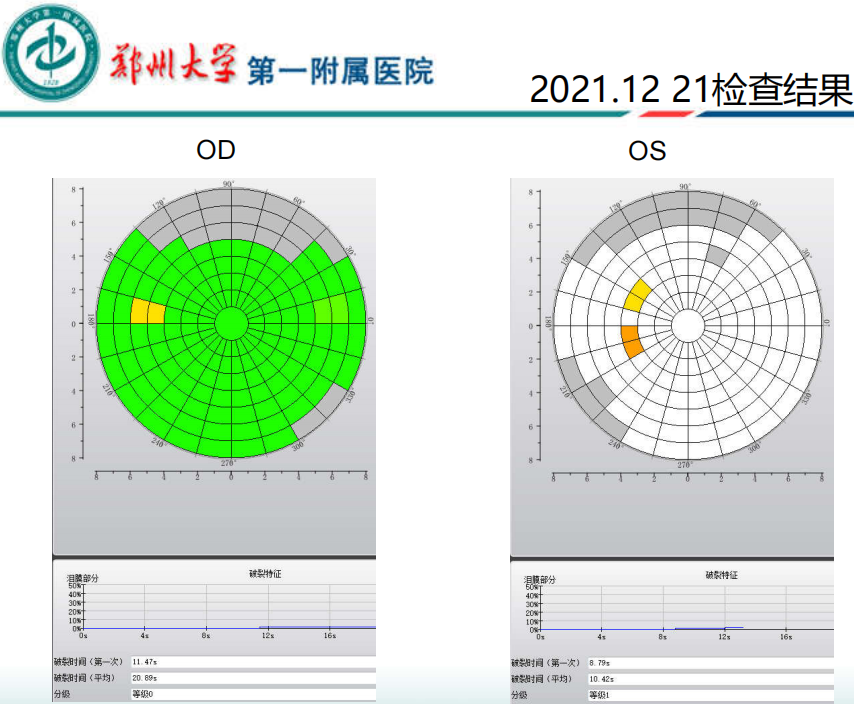 治疗后泪膜破裂时间检查