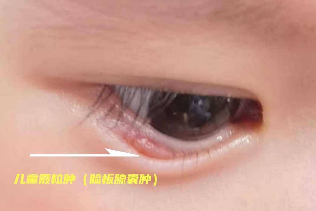 儿童霰粒肿