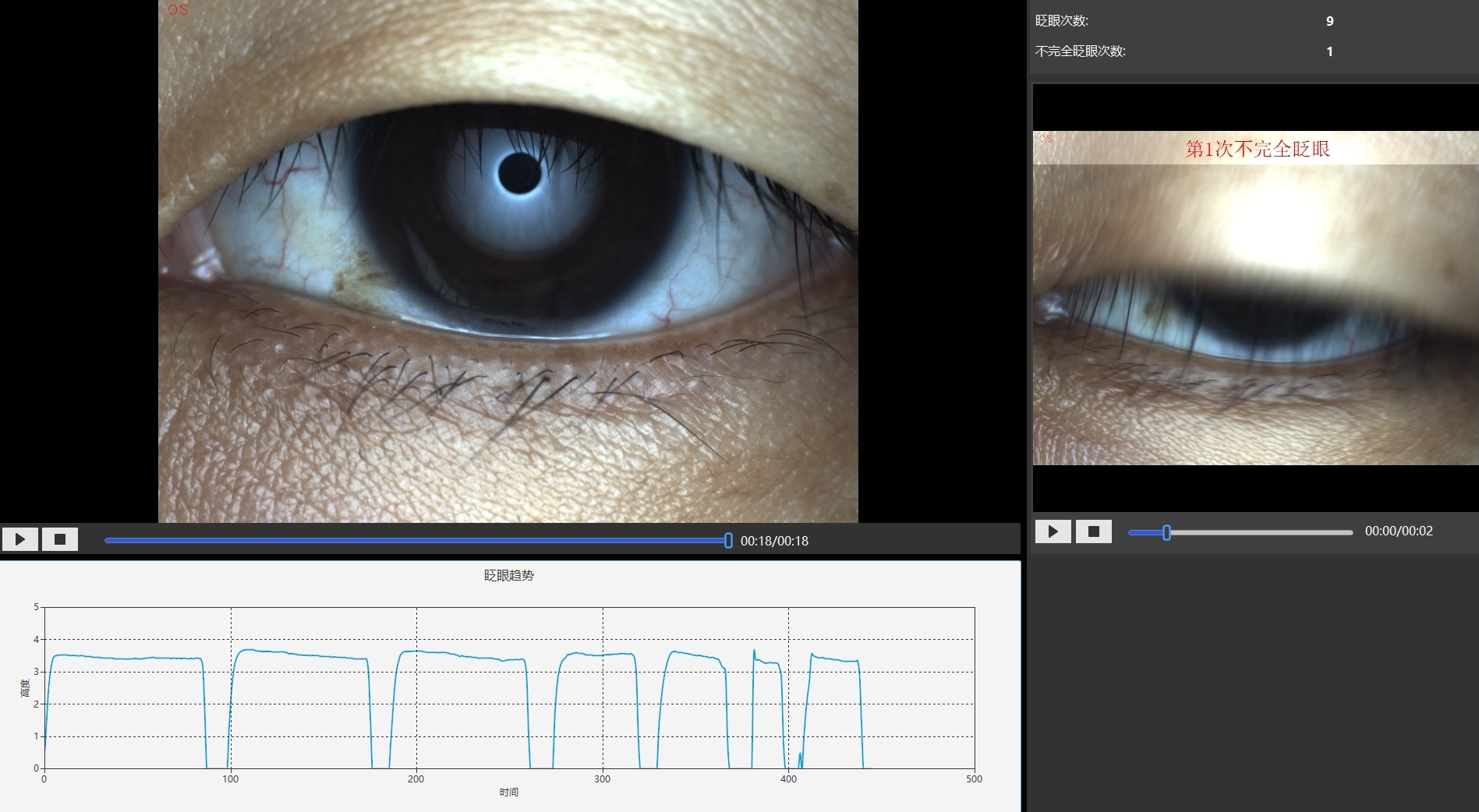 EYESIS干眼综合检查仪测试眨眼次数