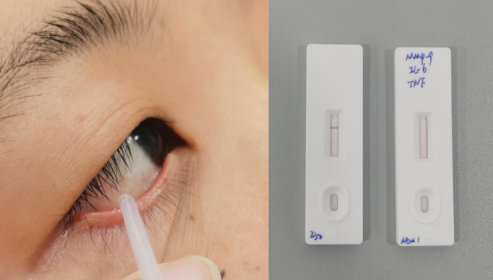 使用POCT检测泪液成分来评估干眼