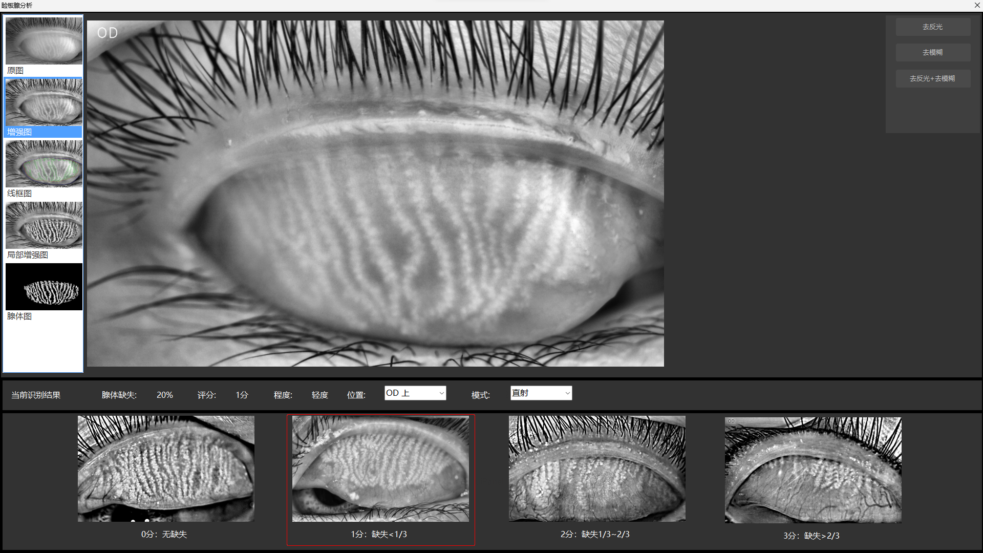 EYESIS干眼综合检查仪的的睑板腺结构成像检查