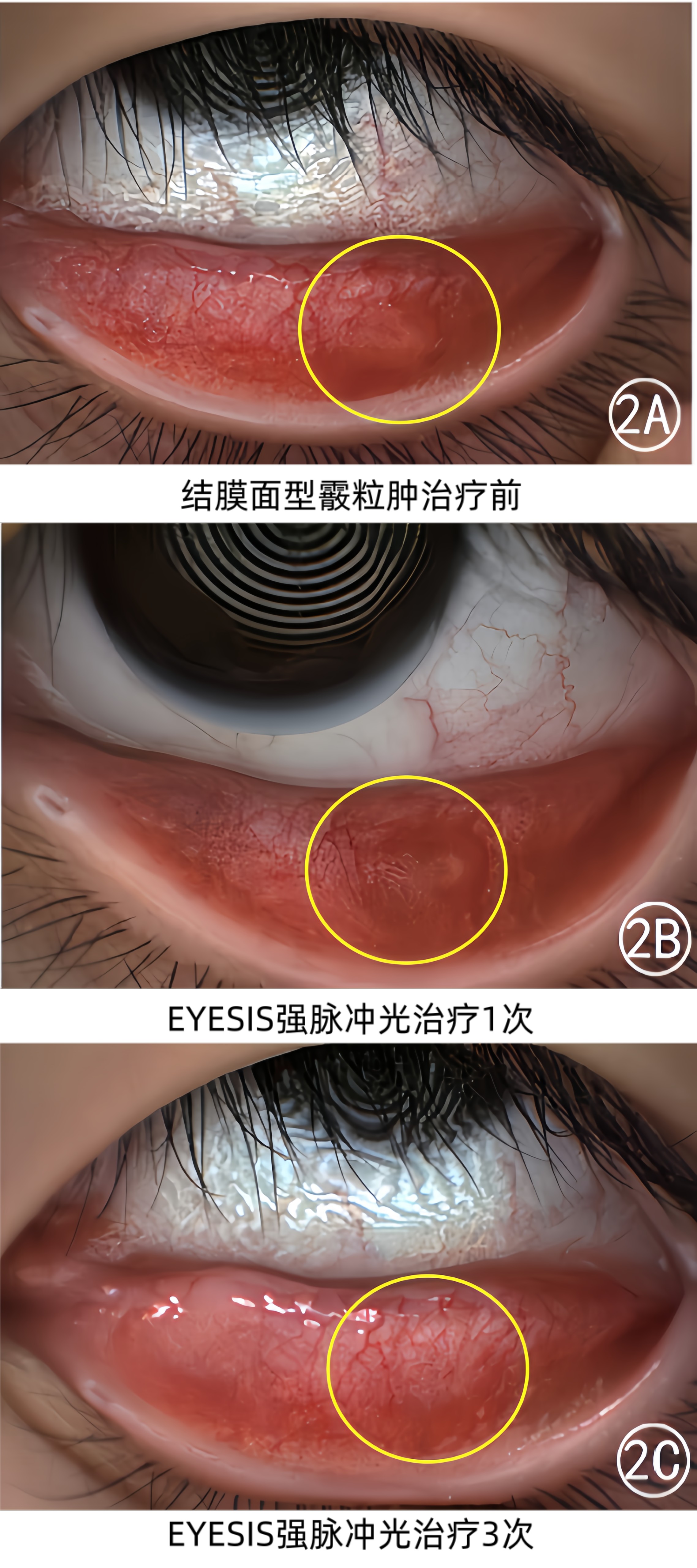 结膜面型霰粒肿强脉冲光治疗前后效果对比