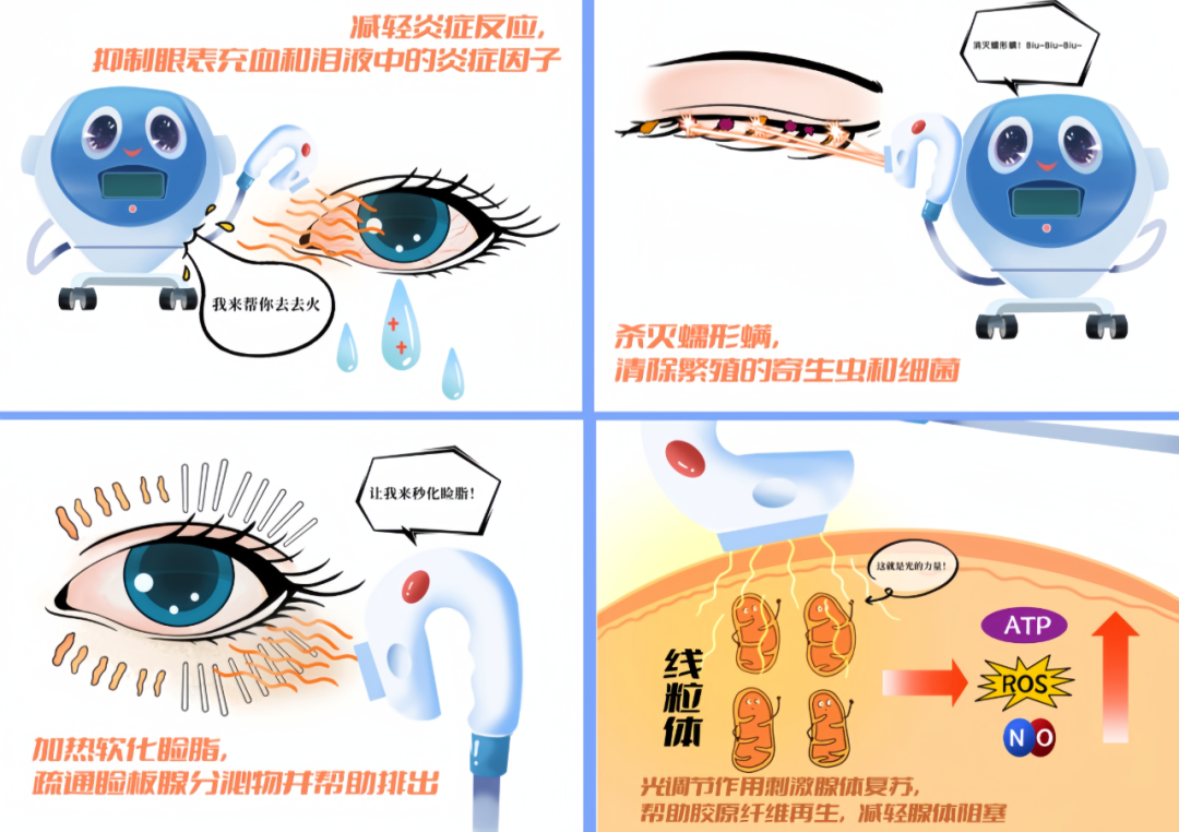 强脉冲光治疗干眼的作用机制