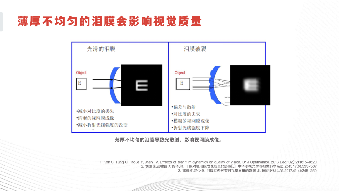 薄厚不均匀的泪膜会影响视觉质量